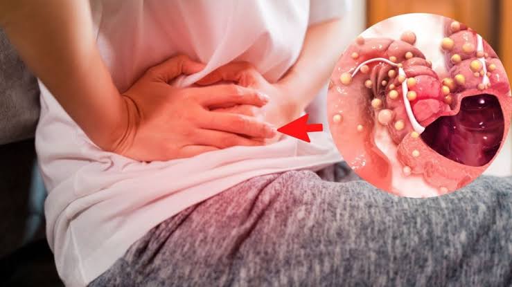 Prevención y detección temprana, claves para combatir el cáncer de colon