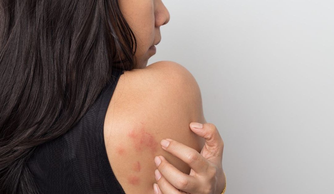 Estrés y ansiedad: dermatólogo advierte aumento de brotes, acné y caída del cabello en pacientes
