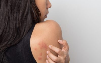Estrés y ansiedad: dermatólogo advierte aumento de brotes, acné y caída del cabello en pacientes